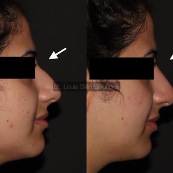 St. Louis Skin Solutions - Before & After a Non-Surgical Rhinoplasty using Dermal Fillers - Laser Hair Removal Near Me - St. Louis, Missouri St. Louis Skin Solutions - Before & After a Non-Surgical Rhinoplasty using Dermal Fillers - Laser Hair Removal Near Me - St. Louis, Missouri