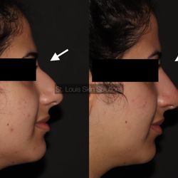 St. Louis Skin Solutions - Before & After a Non-Surgical Rhinoplasty using Dermal Fillers