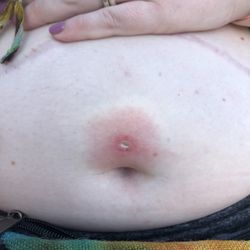 Sideshow Tatoo Studio - This was ab a week after taking it out. It was literally about to pop through my skin and get stuck somewhere in my stomach.