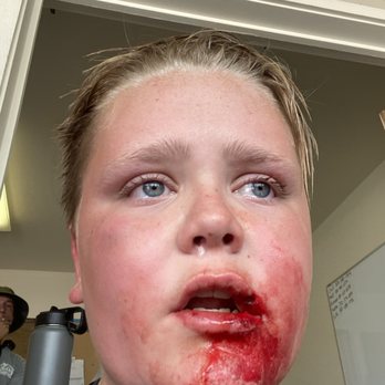 Splash Summit Waterpark - after i hit my head on the slide. - Water Parks Near Me - Provo, Utah Splash Summit Waterpark - after i hit my head on the slide. - Water Parks Near Me - Provo, Utah