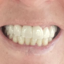 Michael P Folck, DDS - After ! This is not worth  19k ! Like  classic narcissist they try to make it like you are the cause for them not doing their job  right