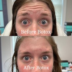 Skinja Medspa - Before and after Botox