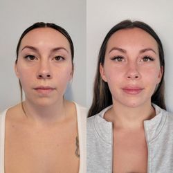 Cheeky Denver - Lip injections and botox at Denver's best medspa.