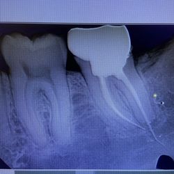 Montano Family Dentistry - My perfectly good tooth