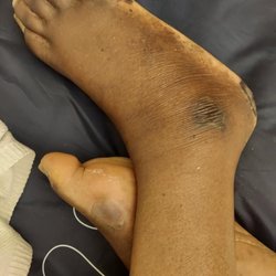Big Bend Woods Healthcare Center - Pictures of the bed sores and ulcers my dad obtained at Big Bend Woods
