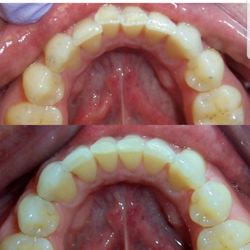 Rockstar Family Dental - Before & After Invisalign treatment