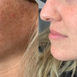 TN Esthetics Center - Sun spots are so last summer. Clearer skin in just 3 treatments with Lumecca Peak IPL.
