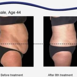 Body Language Relaxation Spa - Laser contour for slimming