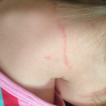 Nice Cuts - Cuts caused by "Nice Cuts" hairdresser on 3 year-old girl's neck. - Men's Hair Salons Near Me - San Francisco, California Nice Cuts - Cuts caused by "Nice Cuts" hairdresser on 3 year-old girl's neck. - Men's Hair Salons Near Me - San Francisco, California
