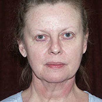 Paramount Plastic Surgery - Before Facelift - Cosmetic Surgeons Near Me - Smyrna, Georgia Paramount Plastic Surgery - Before Facelift - Cosmetic Surgeons Near Me - Smyrna, Georgia