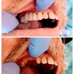 Woodside Family Dental - Bridge restoration