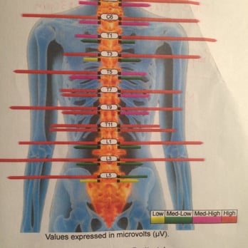 Healing Waves Wellness - Super cool test by Dr. Chambers. The top line shows where my spine started, and the line below is my spine now. SO MUCH BETTER! Thank you!! - Chiropractors Near Me - Santa Cruz, California Healing Waves Wellness - Super cool test by Dr. Chambers. The top line shows where my spine started, and the line below is my spine now. SO MUCH BETTER! Thank you!! - Chiropractors Near Me - Santa Cruz, California