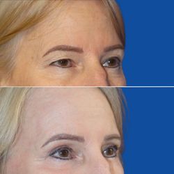 Brett Stompro, MD & Chester Cheng, MD - Upper  Blepharoplasty- Dr. Stompro