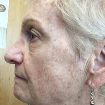 Parvin Shafa, MD - This is only one month later! I am very pleased! Thanks Dr. Shafa! - Dermatologists Near Me - Irvine, California