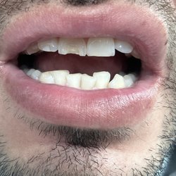 Greenberg Dental & Orthodontics - The tooth they worked on is obvious. Completely incompetent.
