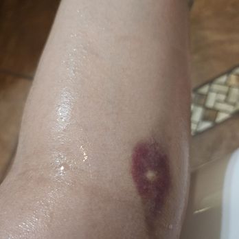 Huntington Health - Here is the IV that is still bruised over 80+ hours later. - Hospitals Near Me - Pasadena, California Huntington Health - Here is the IV that is still bruised over 80+ hours later. - Hospitals Near Me - Pasadena, California