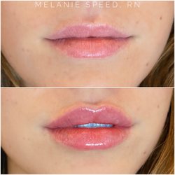 The Beverly Hills Medspa - Before and after lip augmentation results by Melanie Speed, RN.