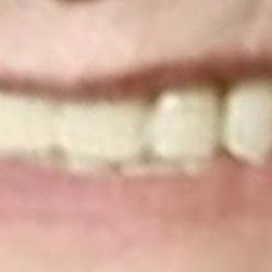 Carlos Abreu - A Hollywood 1 Million Dollars Smile for the FRACTION of it ! Be secure at biting and chewing with confidence !