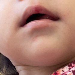 Busted lip