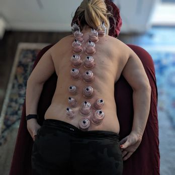 Internal Sunshine Holistics - Full back cupping treatment. - Massage Therapy Near Me - Las Vegas, Nevada Internal Sunshine Holistics - Full back cupping treatment. - Massage Therapy Near Me - Las Vegas, Nevada