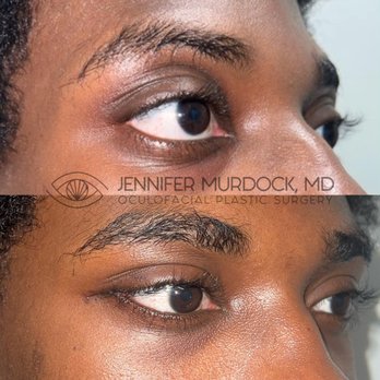 Jennifer Murdock, MD - Orbital decompression for Thyroid Eye Disease - Ophthalmologists Near Me - Miami, Florida