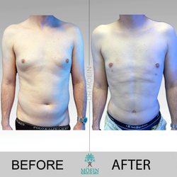 Liposuction Center Moein Surgical Arts - Gynecomastia Surgery
