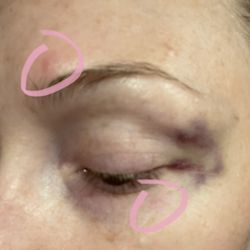 California Cosmetics - Allergic reaction maybe? And very bad bruising