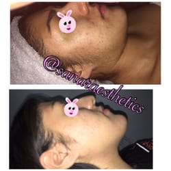 Sanar Aesthetics - Client before and after Dermaplaning.