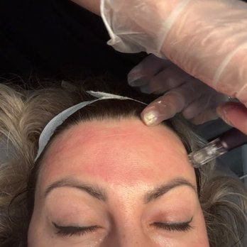 Alera Med Spa - MICRONEEDLING - Medical Spas Near Me - Wesley Chapel, Florida