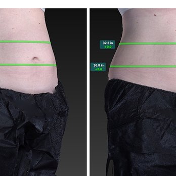 Aesthetic Solutions - CoolSculpting for the abdomen - Dermatologists Near Me - Chapel Hill, North Carolina