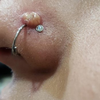 Modern Mods - Arrowhead  - My infection over a keloid. - Piercing Near Me - Glendale, Arizona