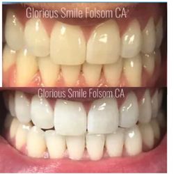 Glorious Smile Natural Teeth Whitening