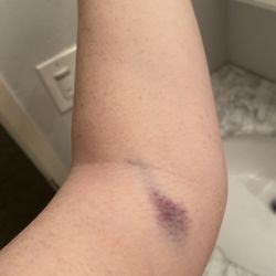 WestPac Labs - Next day bruising