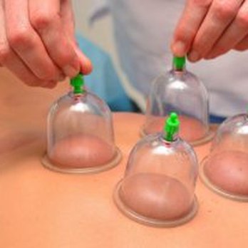 Stone Mountain Medicine - Cupping improves circulation to tight and fatigued muscles - Traditional Chinese Medicine Near Me - Berkeley, California Stone Mountain Medicine - Cupping improves circulation to tight and fatigued muscles - Traditional Chinese Medicine Near Me - Berkeley, California