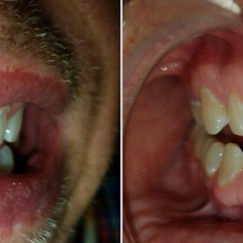 Showstoppers Teeth Whitening Studios - My brother's after (1st pic) and before. BIG difference! - Teeth Whitening Near Me - Allen, Texas Showstoppers Teeth Whitening Studios - My brother's after (1st pic) and before. BIG difference! - Teeth Whitening Near Me - Allen, Texas