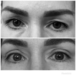 Skinzone Medical: Hannah Vu, MD - Before and 8 days after eyelid surgery