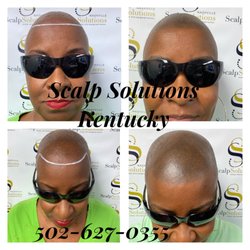 Scalp Solutions Kentucky - Scalp Micropigmentation (SMP) Before & After