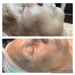 Anti-aging facial