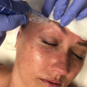 Skin Deep MD - Rejuvenate with Microneedling - Medical Spas Near Me - Boulder, Colorado Skin Deep MD - Rejuvenate with Microneedling - Medical Spas Near Me - Boulder, Colorado