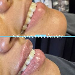 Brows By Heba  - Lip filler