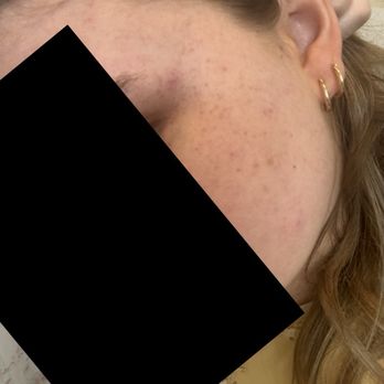 KPOT Korean BBQ & Hot Pot - Terrible breakouts. - Korean Near Me - Ocala, Florida KPOT Korean BBQ & Hot Pot - Terrible breakouts. - Korean Near Me - Ocala, Florida