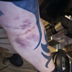 BioLife Plasma Services - It's called a hematoma or internal bleeding.