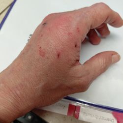Erlanger Baroness Hospital - Cat bite to hand