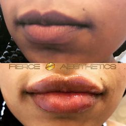 Fierce Aesthetics - Add desired range of fullness to plump lips with Juvederm