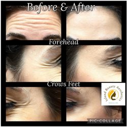 Island Beauty Aesthetics - Transform Your Look with Botox at Island Beauty Aesthetics Meds Spa!