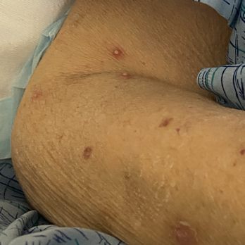 Ahwatukee Post Acute - Infected ant bites in bed. - Skilled Nursing Near Me - Phoenix, Arizona Ahwatukee Post Acute - Infected ant bites in bed. - Skilled Nursing Near Me - Phoenix, Arizona