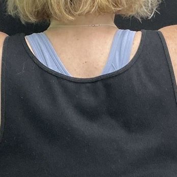 The Plastics Doc & Med Spa - After 7 weeks - Plastic Surgeons Near Me - Corona, California The Plastics Doc & Med Spa - After 7 weeks - Plastic Surgeons Near Me - Corona, California