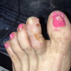 Advanced Foot & Ankle Care Centers - O blister off of toe infected
