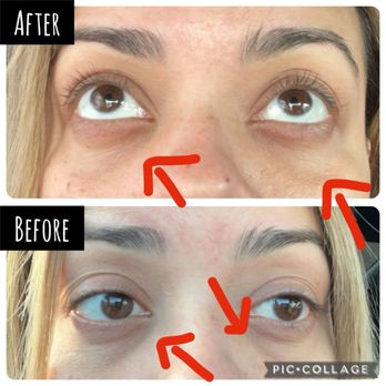 Saint Aesthetix - Under eye - Medical Spas Near Me - Monrovia, California Saint Aesthetix - Under eye - Medical Spas Near Me - Monrovia, California