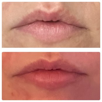 Med Physique Center For Aesthetics - AFTER 1.5 syringes of restalyn kysse..... something doesn't add up. - Medical Spas Near Me - Austin, Texas